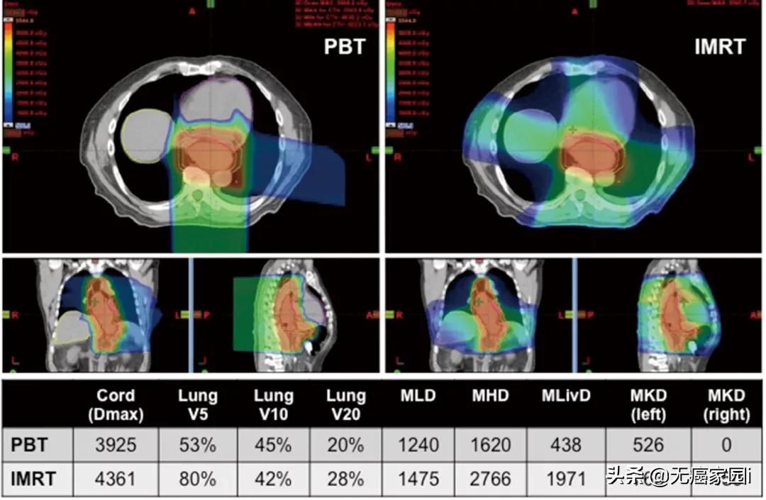 质子治疗消化道肿瘤,质子重离子治疗肠胃瘤