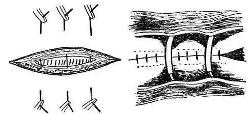 外科8种缝合方法图解,外科基本缝合方法实验报告
