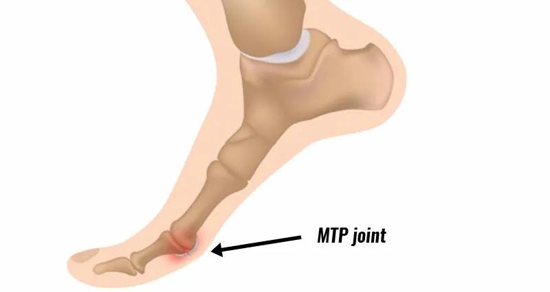 前脚掌疼痛,前足疼