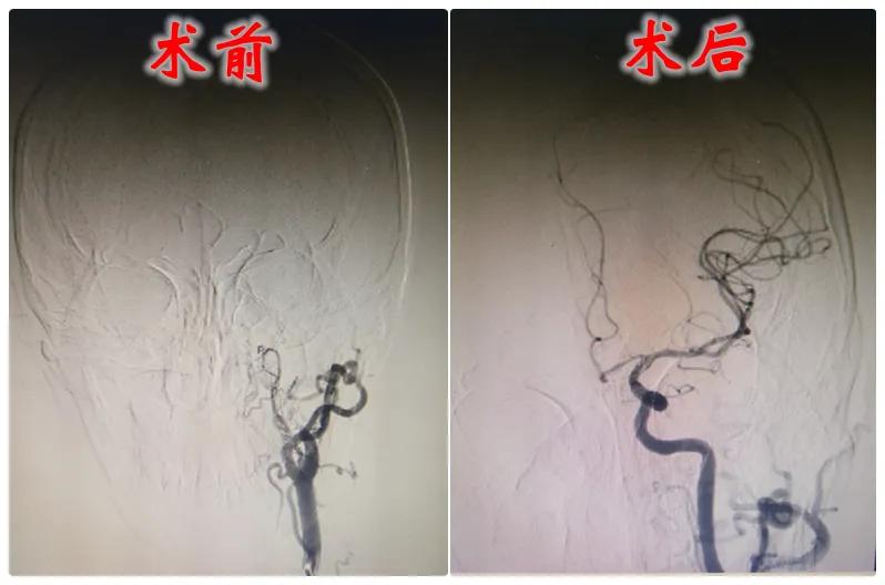 神经介入手术在哪穿刺,血管介入栓塞手术找哪个科