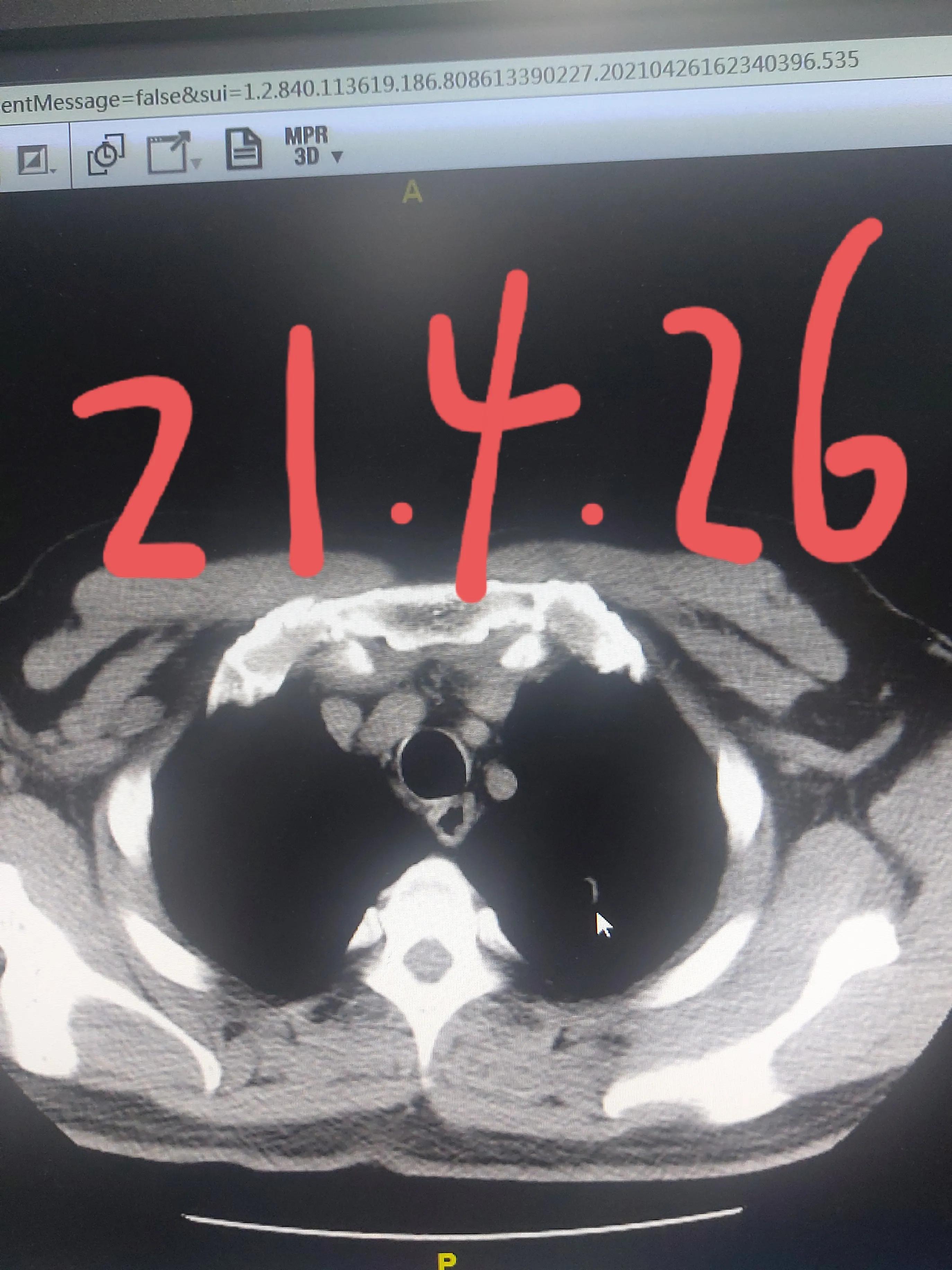 刘懿博士肺癌治疗,刘懿博士说肺癌晚期合并脑梗