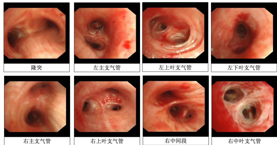 「梦里与丈夫吵架」醒来后咯血，是什么导致了她右侧支气管阻塞？