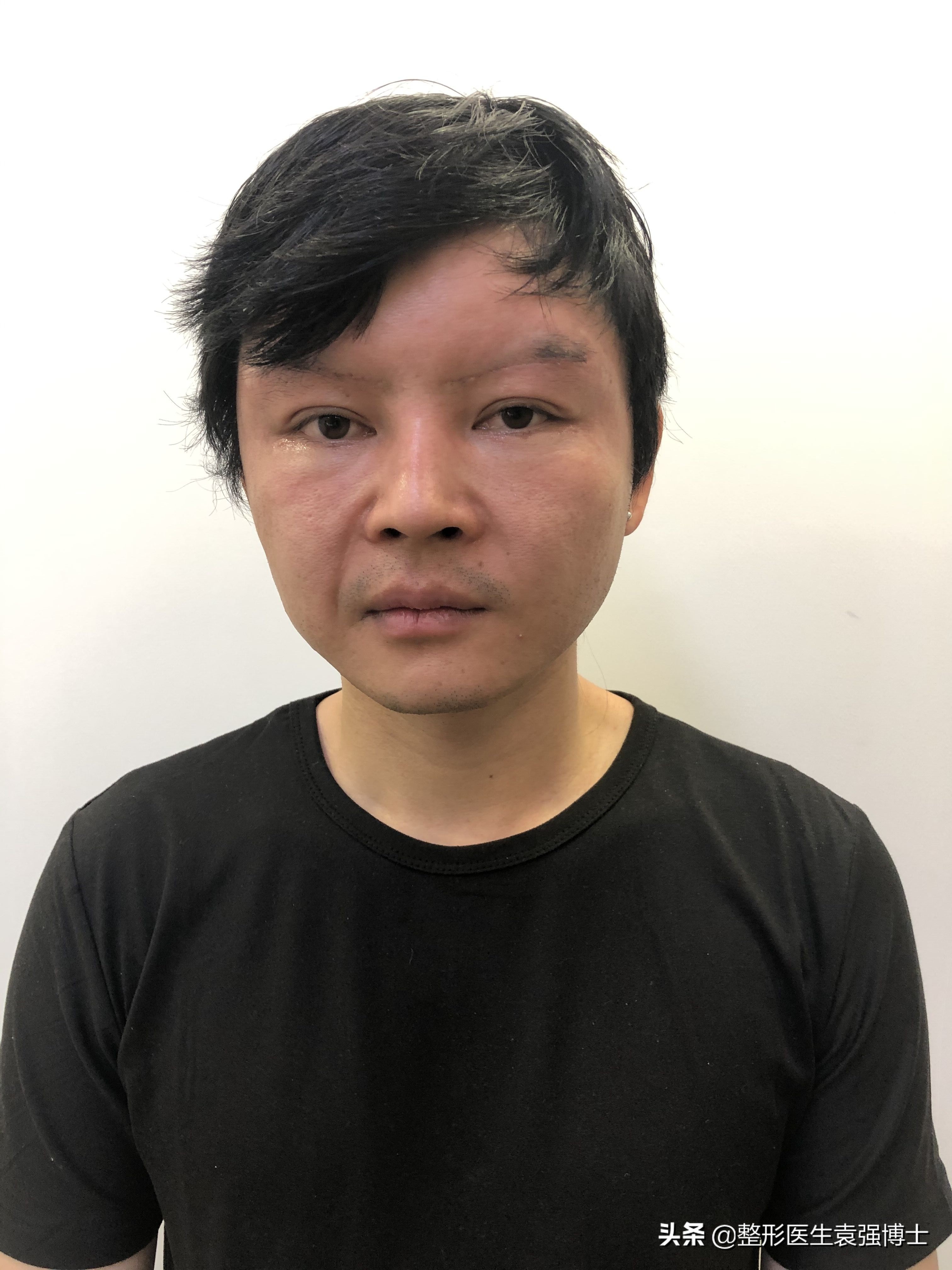 30岁小拉皮手术后7天照片,30岁拉皮恢复过程图片