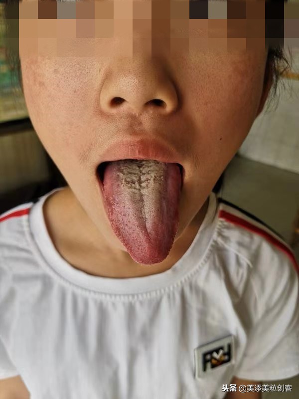 肠胃湿热症导致的闭口开口粉刺痘，这样对症而治少走很多弯路！