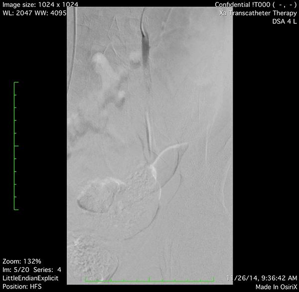 男性不育精索静脉曲张好治吗,精索静脉曲张性男性不育诊断标准