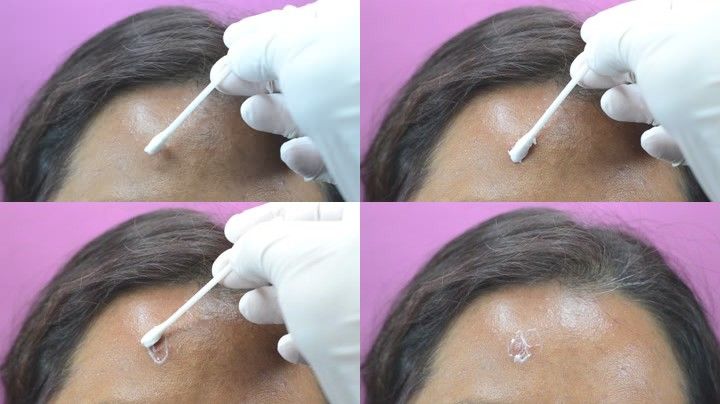 痘印痘坑消炎修复药膏,什么样的痘痘会留痘印痘坑