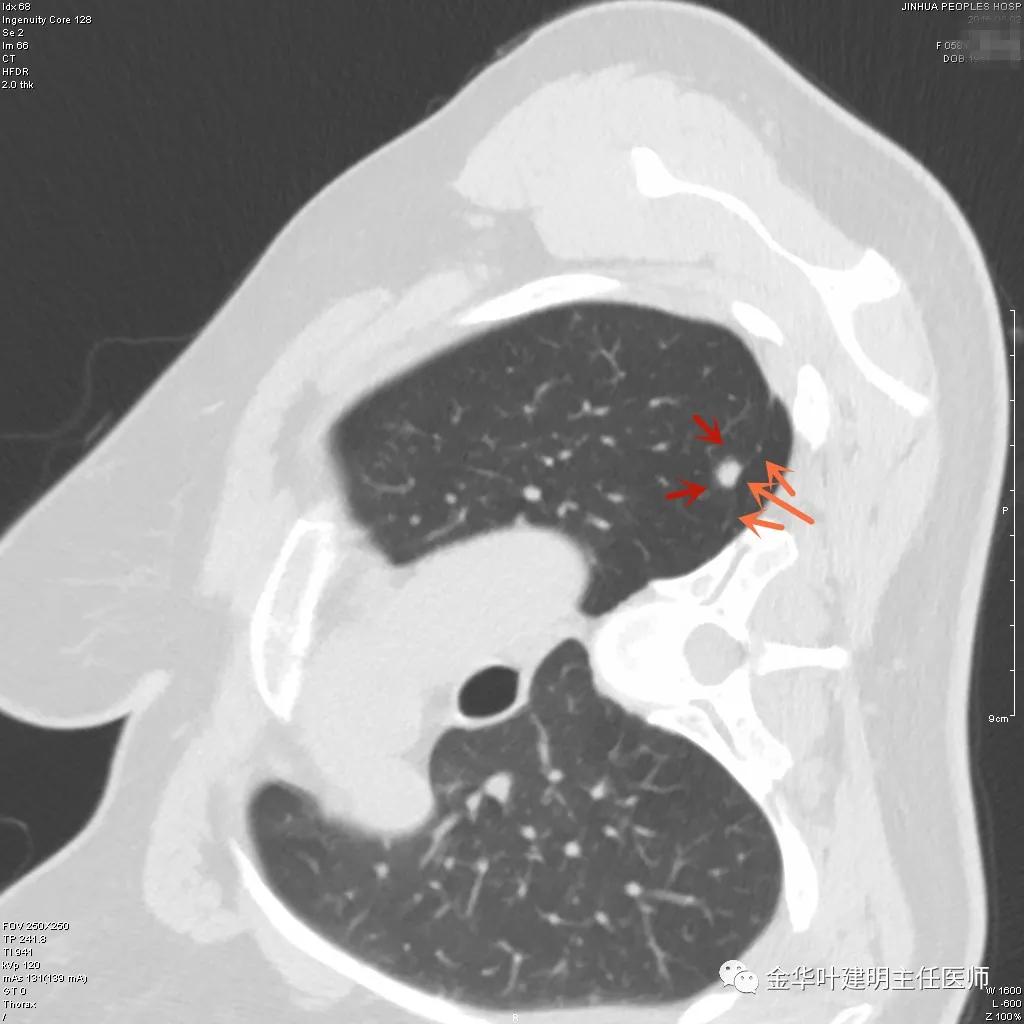 叶建明谈实性结节,叶建明肺实性良性结节会变癌症吗