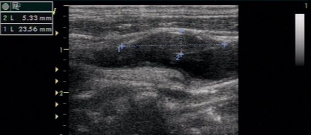 颈动脉斑块有哪些症状和危害,颈动脉有斑块能搓揉吗
