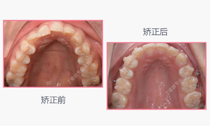 单颗牙隐形矫正,郑州隐形矫正牙齿哪家便宜