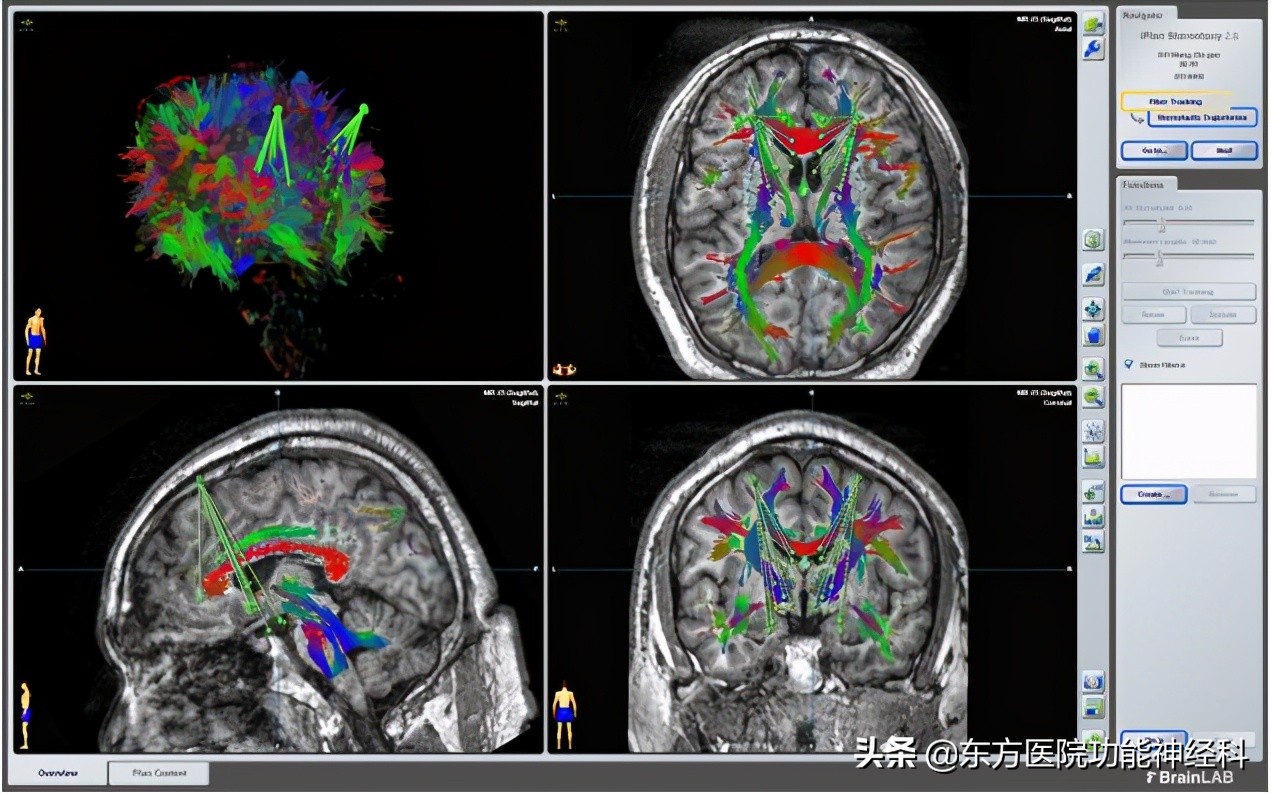 被误诊为双相情感障碍怎么办,双相情感障碍症医生问诊
