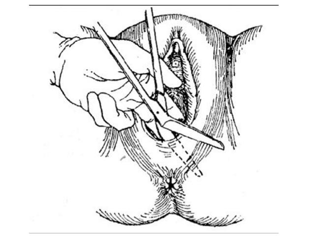 产妇“侧切”后影响夫妻生活?产科医生给出解释,并提出建议
