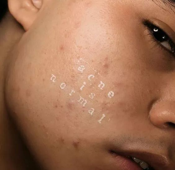 脸上长痘痘吃维生素c有效吗,脸上长痘痘吃什么水果最好呢