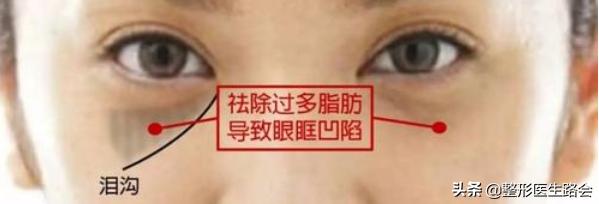祛眼袋泪沟最靠谱的方法,遮眼袋泪沟最好用的方法