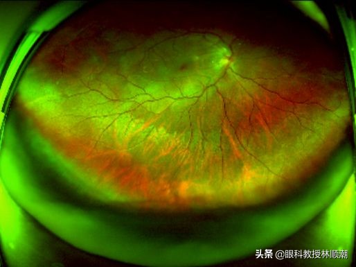 50岁男子用头顶了个球,晶状体脱位,悲剧了