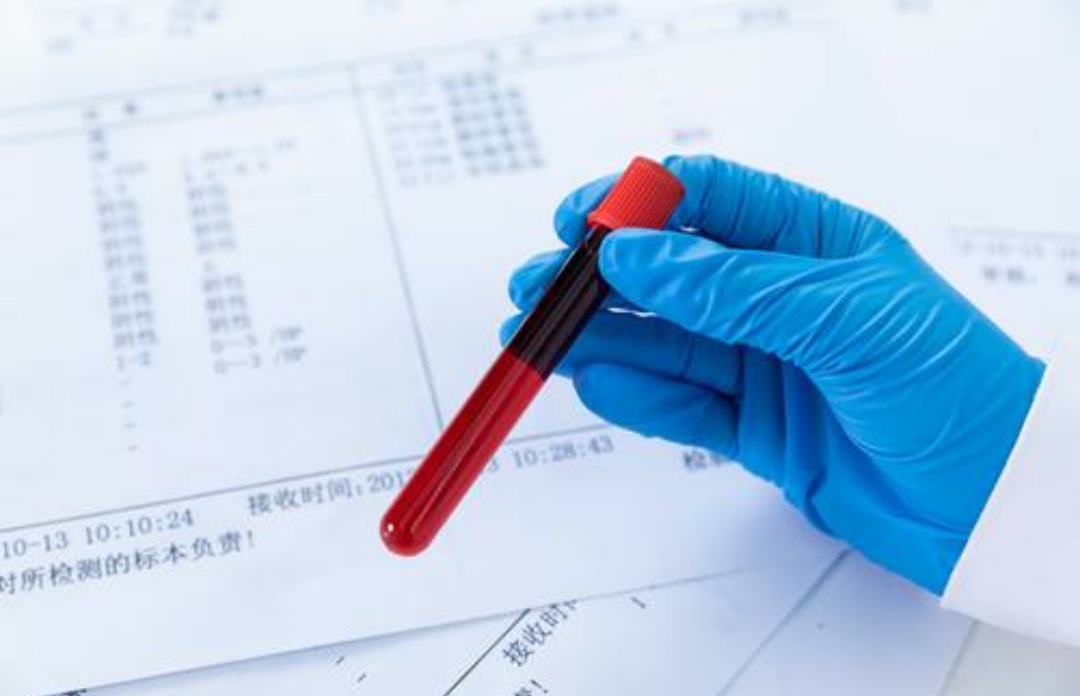 非典型溶血性尿毒症的发病几率,非典型溶血性尿毒症国外治疗