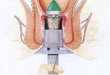 痔疮是人类为直立行走付出的代价