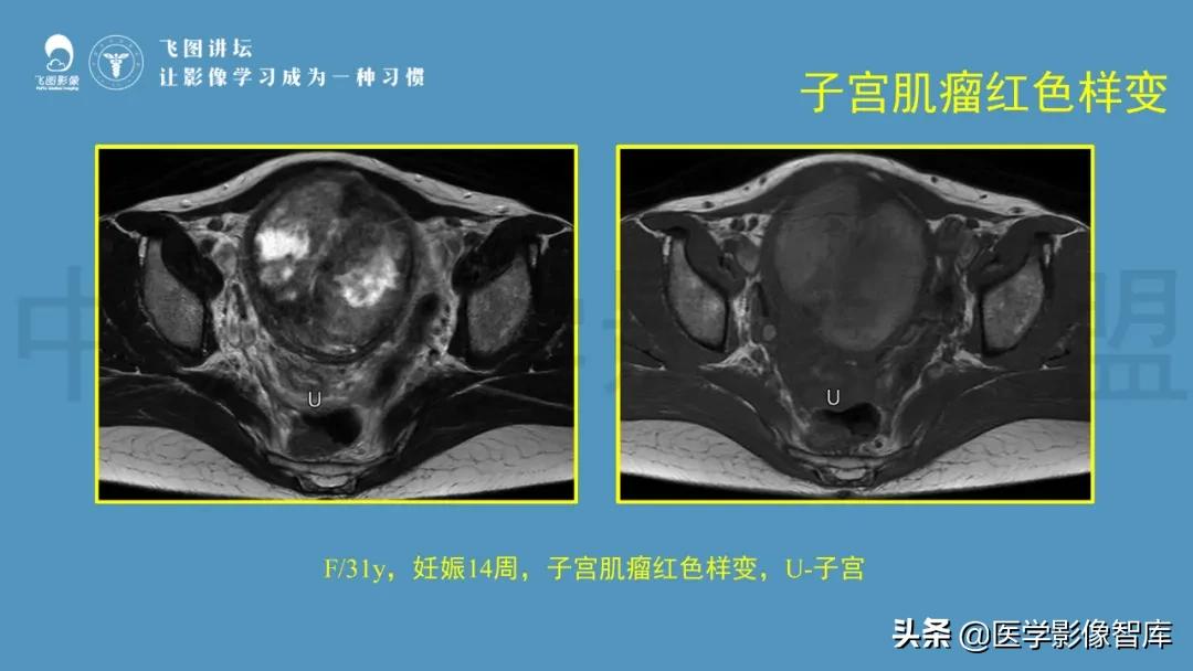 子宫解剖结构输卵管和卵巢位置,子宫附件ct影像学正常解剖表现