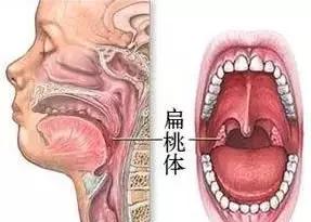 孩子喉咙化脓反复高烧什么原因,喉咙化脓反复高烧怎么办好得快