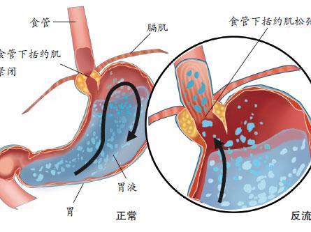 什么是霉菌性食道炎?得了霉菌性食道炎主要有哪些症状?