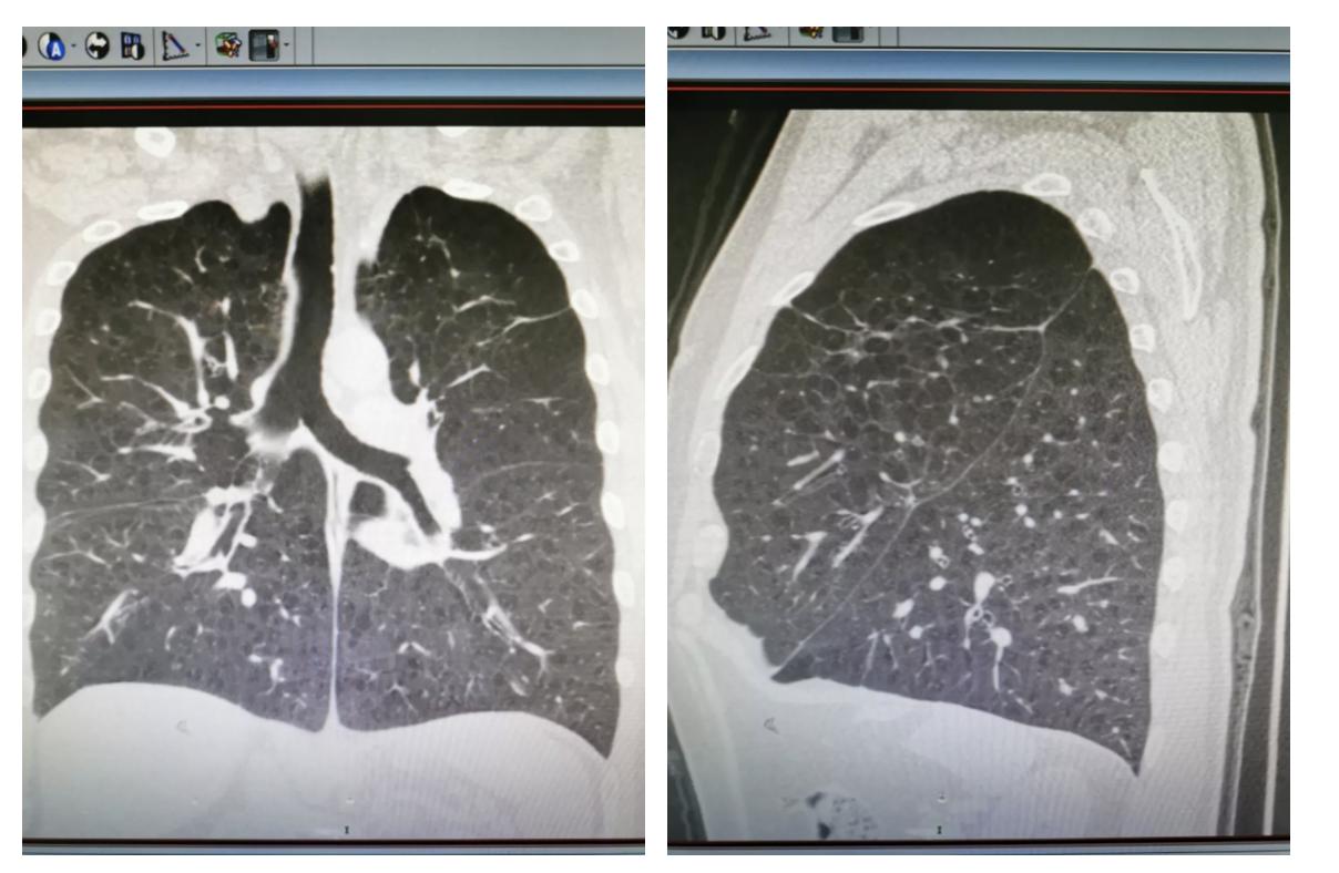 慢阻肺是桶状胸,慢阻肺会出现桶状肺吗