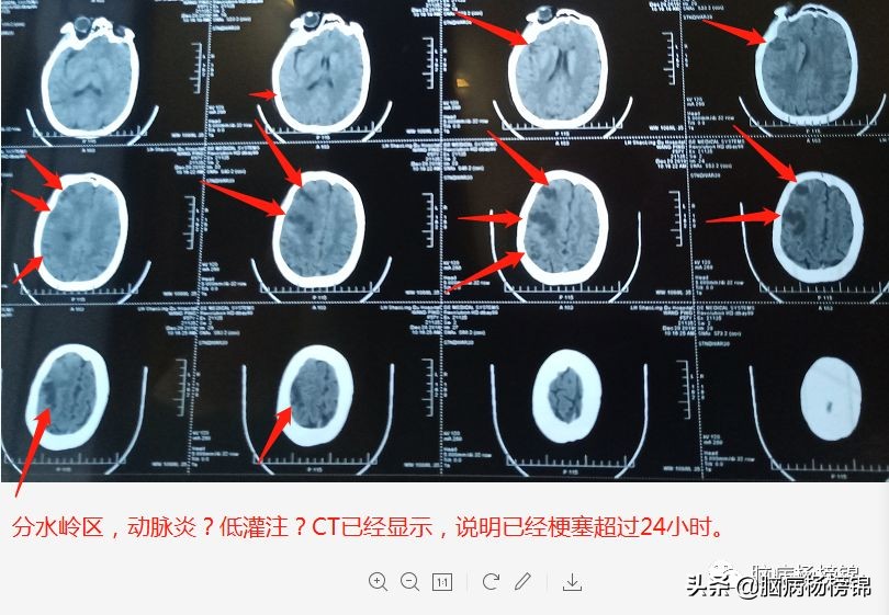 脑梗塞病人拉肚子怎么办,感冒会引起脑梗头晕的加重吗