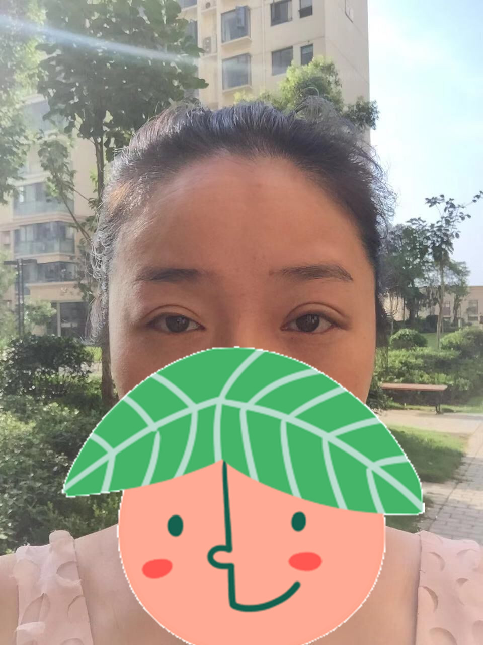 提肌矫正失败的表现眼皮睁不开,做完提肌眼睛前半段下垂