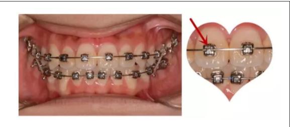 牙齿矫正有几种方式,牙齿矫正刷牙方式视频