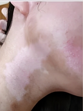 白癜风是个什么,白癜风到底是什么