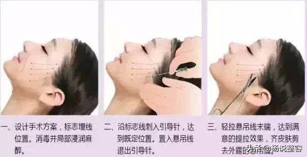 5000元的线雕和5000元线雕的区别,5万元线雕价格