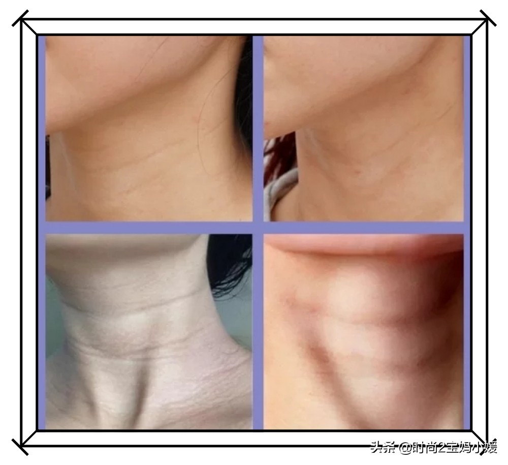 女星脖颈纹怎么处理,女明星脖子的颈纹