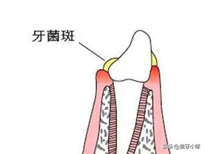 没有蛀牙就感觉有个洞,没有蛀牙但是隐约感觉有点牙疼