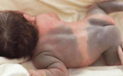 如何避免宝宝身上有胎记,宝宝有了胎记妈妈怎么办