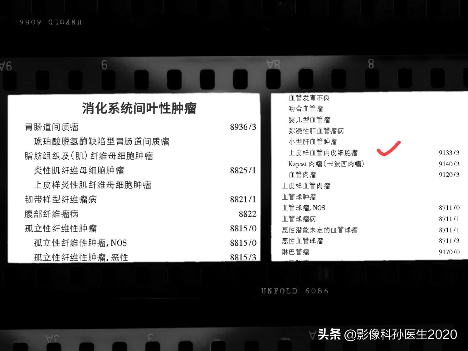 肝上皮样血管内皮瘤全国多少例,肝上皮样血管内皮瘤超声表现