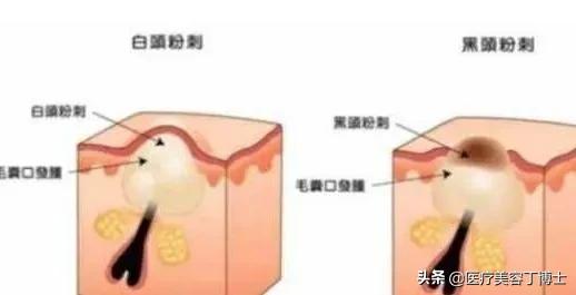 毛孔粗大皮肤又干是什么肤质,毛孔粗大的克星怎么解决