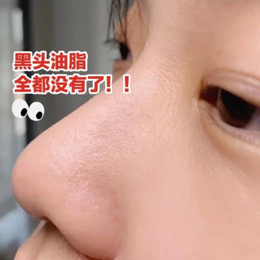 深度清理毛孔黑头教程,清洁毛孔里的黑头和白头小妙招