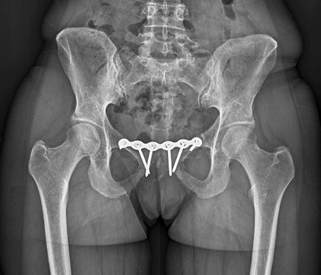 教你练成完美身材,3——如何矫正假胯宽