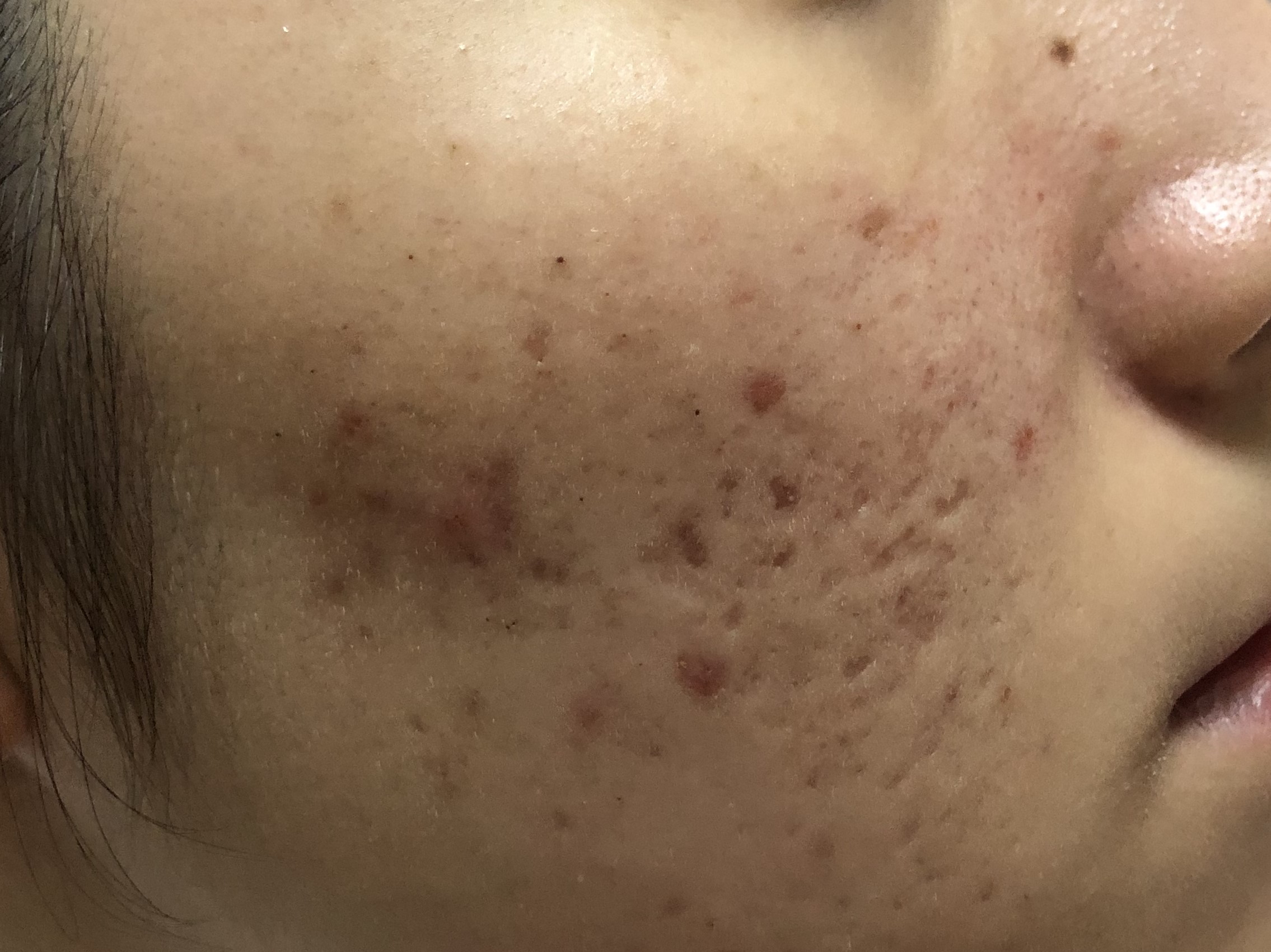 17岁女儿脸上长很多痘痘粉刺,12岁女儿脸上长满痘痘怎么办