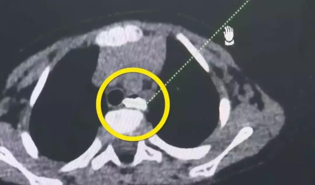 小孩子误食玻璃片怎么办,小孩吞了玻璃片有什么症状