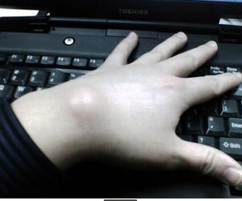 腱鞘囊肿怎样快速消除小妙招,腱鞘囊肿消除小妙招小视频