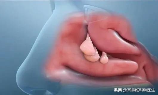 健康科普短视频鼻饲患者,鼻健康科普类短视频