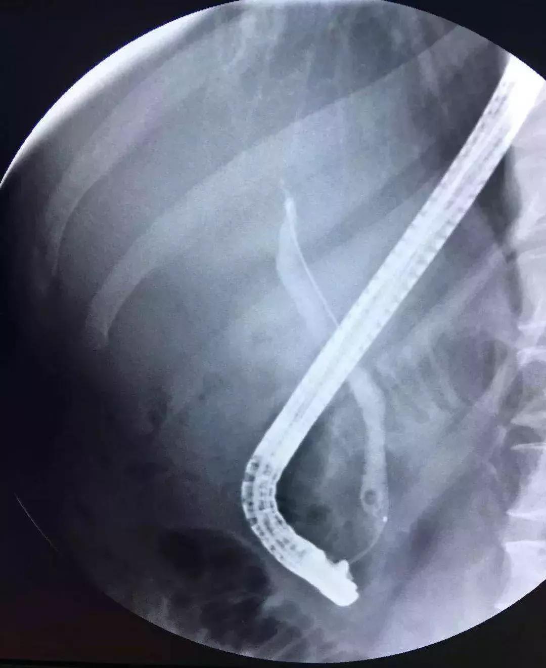 急性胆管炎会不会传染黄疸,胆囊炎和胆管炎会出现黄疸嘛