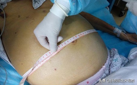 小肚子大腹水是什么原因,肚子大怎么看有腹水没有