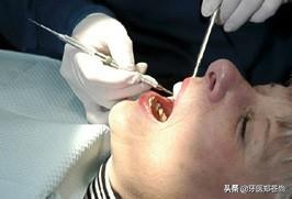 发现有蛀牙一定要补吗,不经意看到自己的蛀牙