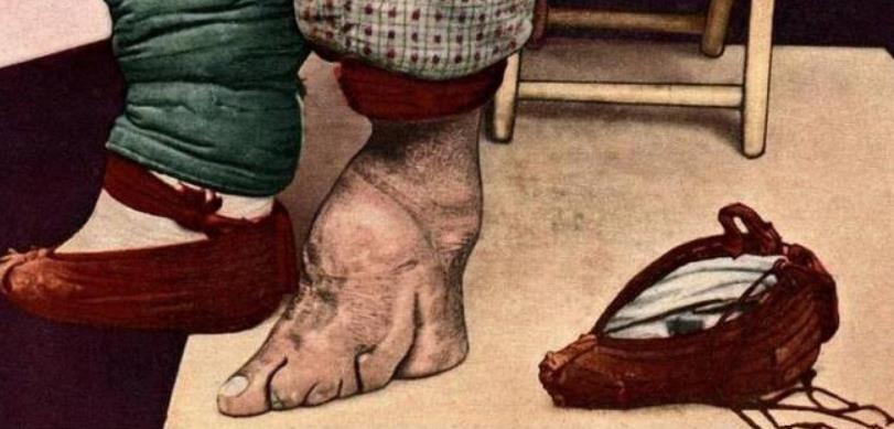 中国女子缠足，西方女子束腰，非洲女子最让人同情，至今仍在