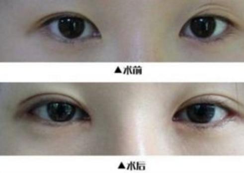做开外眼角,想做眼睛手术不能做怎么办