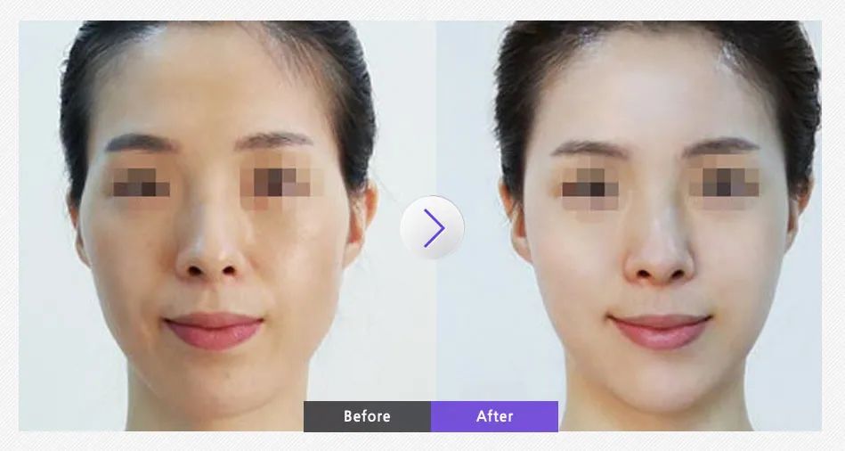 中山哪里假体填充太阳穴,假体填充太阳穴哪里可以做