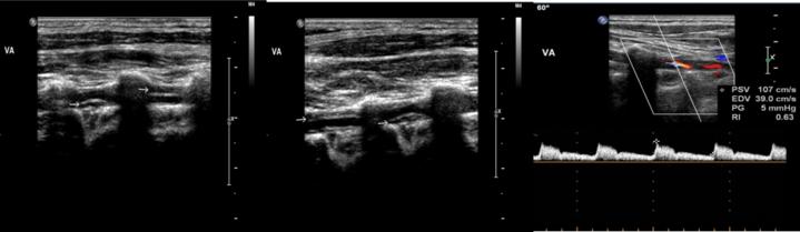 颈部一侧血管破裂,颈部动脉血管破裂