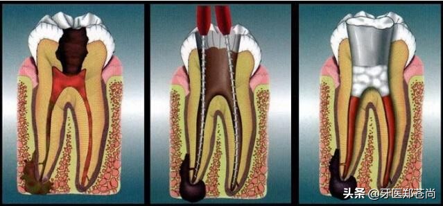 根管治疗有没有一次做完的,根管治疗要做手术吗