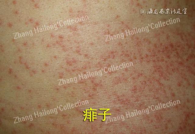 天气热身上长红疹子,一晚上起密密麻麻的疹子