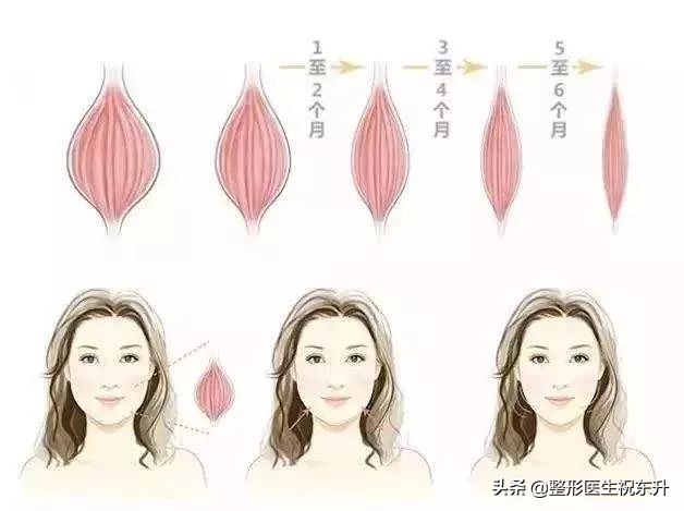 打瘦脸针的亲身经历,打了瘦脸针一年后图片详细记录